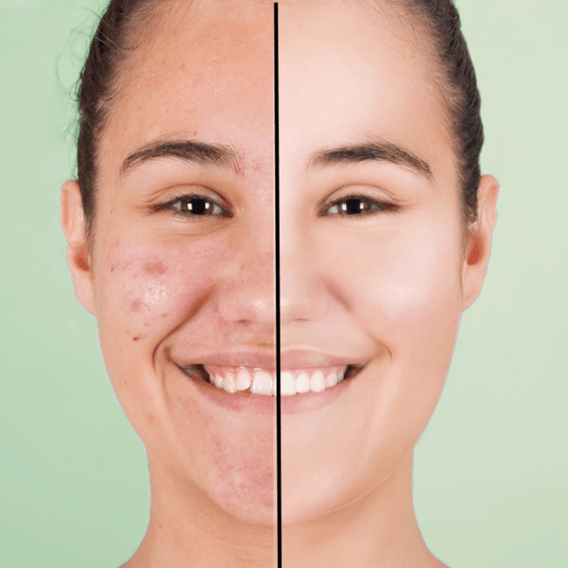 Face Reality Acne Bootcamp